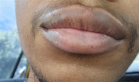 Very Tiny Bumps On Lips