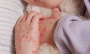 Hand Foot And Mouth Disease While Pregnant