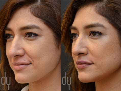Before and After treating Nasolabial Fold (smile lines) with Juvederm ...