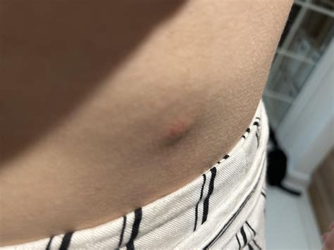 Hard lump on abdomen - advice please : r/DermatologyQuestions