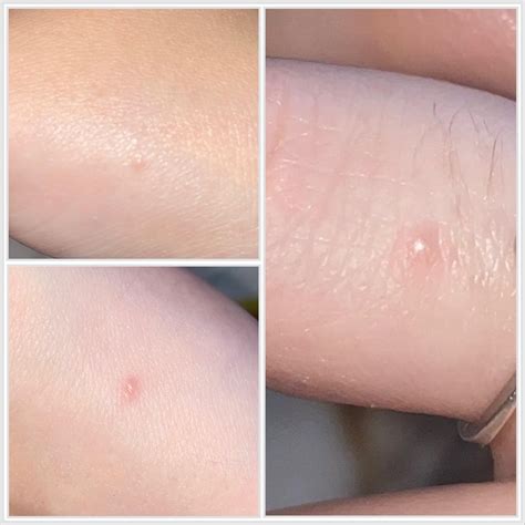 Small itchy bumps appearing on hands, what are they? : r ...