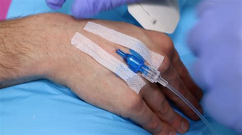 What Are The Different Types Of Iv Cannulation at Harold Barker blog