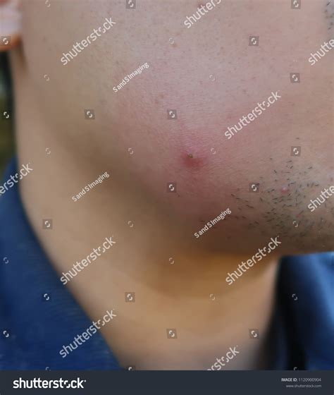 Ingrown Hair On Face