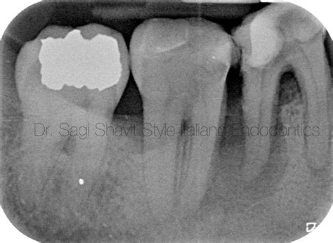 Poor prognosis?... - Style Italiano Endodontics
