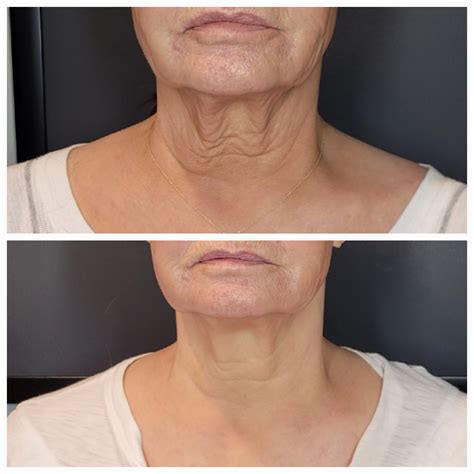 Neck Skin Tightening Benefits Of PDO Thread Lift Neck: A Non Surgical