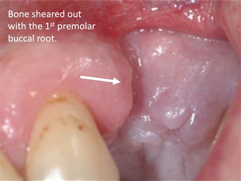 Maxillary 1st Premolar