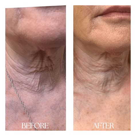 Erbium Laser Resurfacing - New Medical Spa
