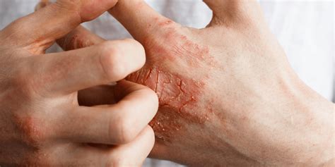 Eczema En La Piel