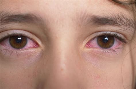 Eye Infections in Kids: Signs & Symptoms to Watch For - Total Vision ...