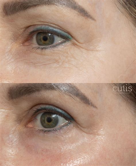 Eye Wrinkle Treatment CO2 Laser - Cutis Clinic