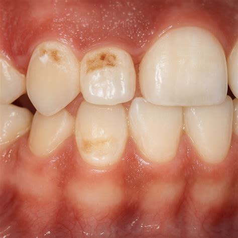 White Spot Lesions (Demineralisation of Teeth) - Cranbourne North Dental