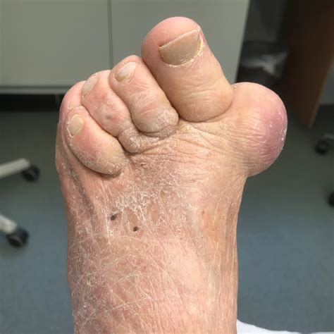 Foot Bunion Outside at Sebastian Belbin blog