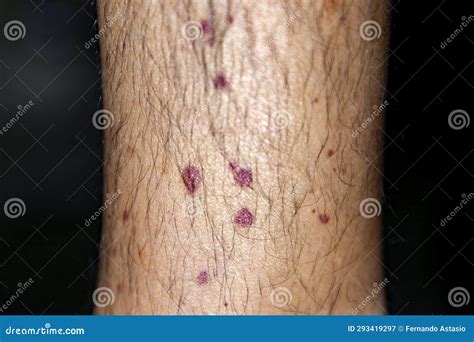 How Rare Is Vasculitis