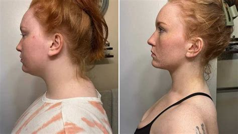 Incredible photos show how woman banished her Dowager's neck hump - and ...