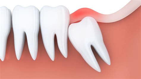The First Signs Of Wisdom Teeth Coming In - Affinity Dental