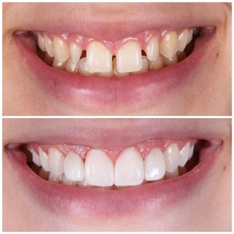 Peg laterals restored with Composite Veneers | Dental veneers, Cosmetic dental treatment ...