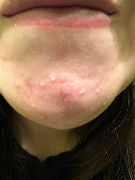 What are these white bumps on my chin?? They can be popped but always ...