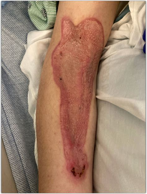 Delayed presentation of amiodarone extravasation-induced skin necrosis ...
