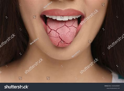 Dehydration Symptoms Tongue