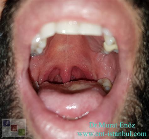 Swollen Uvula After Tonsillectomy