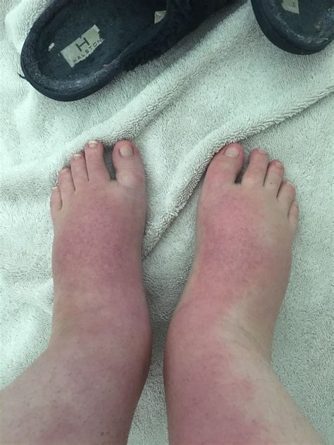Swelling in ankle / top of feet post sunburn. Please help. 😔 Post below. : r/DermatologyQuestions