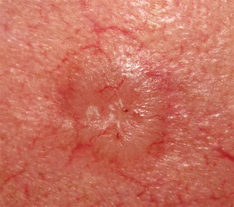 Basal Cell Carcinoma Stages Pictures at Gayla Wilson blog