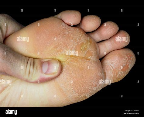 Woman eczema feet hi-res stock photography and images - Alamy