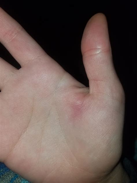 Hello medical people, I work as a dishwasher and got this painful swollen bruise right between ...
