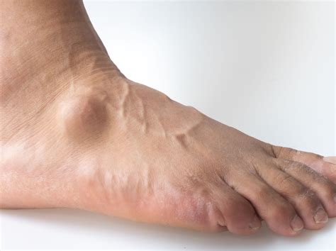 Ganglion Cyst: Foot Pain Causes and Treatment Options - Foot and Ankle Group
