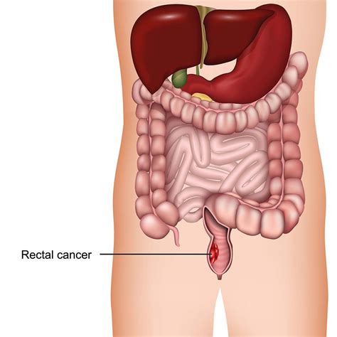 Rectal Cancer Anatomy