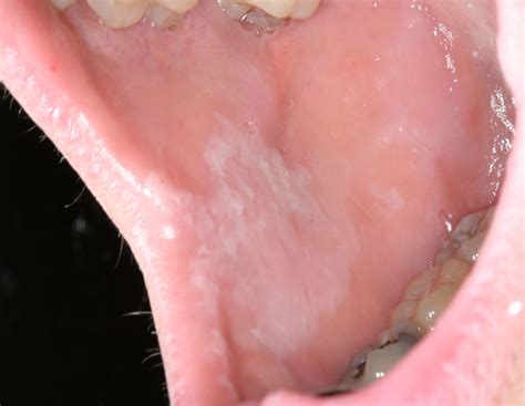 Linea Alba Cheek Biting