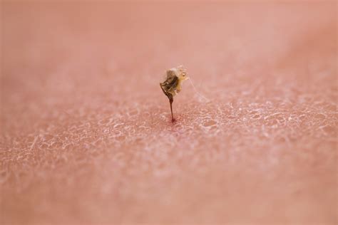 Best Treatment For Multiple Bee Stings at Reynaldo Leahy blog