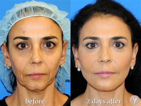 Non Surgical Face Lift Price at Carl Jeffery blog