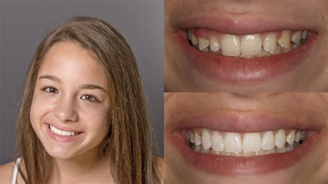 What Does Teeth Bonding Feel Like at Charlie Skirving blog