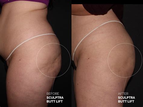 sculptra for booty lifting: the non-surgical route to a perkier bum — frida beauty bar