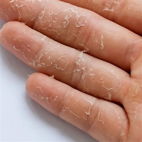 Fungal Infections Symptoms | Understand the Signs - Tagged "Expert ...