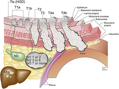 Esophageal Cancer Staging - Thoracic Surgery Clinics