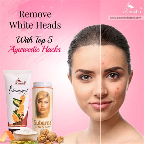 How To Remove Whiteheads