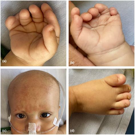 Mexican patient with Ellis‐van Creveld syndrome and cleft palate ...