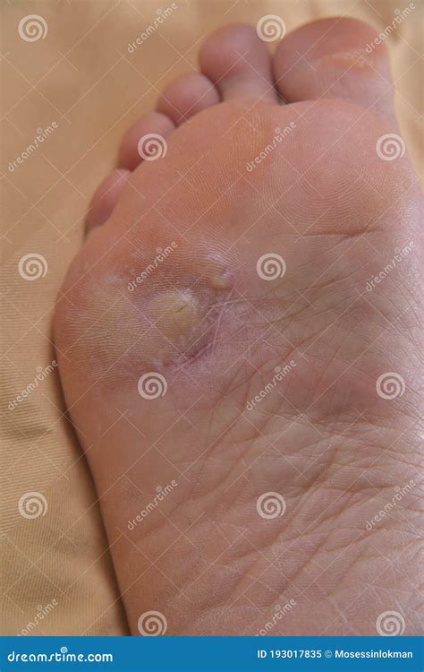Athlete's Foot Blisters