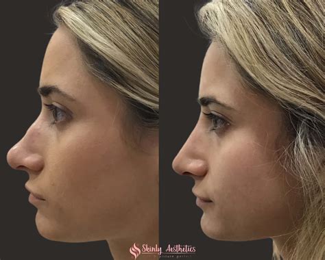 Non Surgical Nose Job Cost
