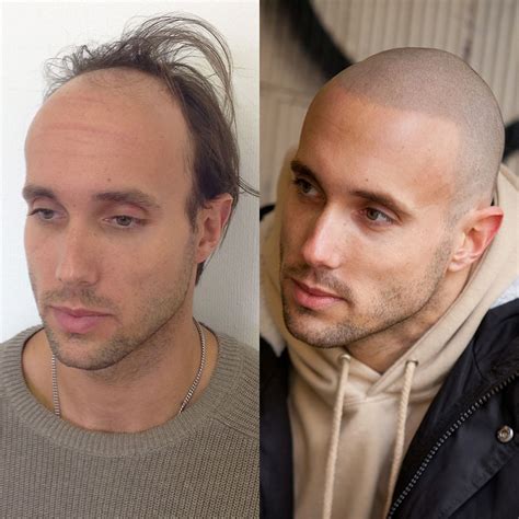 Shining a Light on Shiny Scalps | Haircuts for balding men, Balding ...