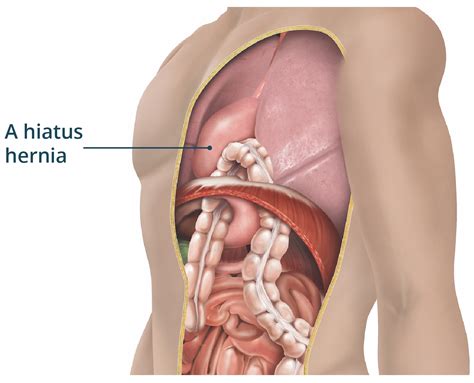 Surgery for large hiatus hernia | healthdirect
