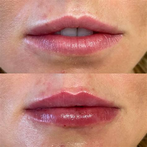 Lip Filler in Lakewood Ranch FL - Natural Results | Serving Bradenton ...