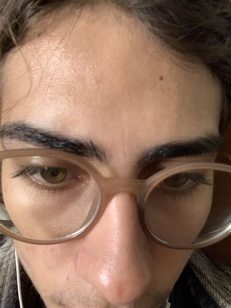 [Skin Concerns] picked at a blackhead the other day. left with this ...