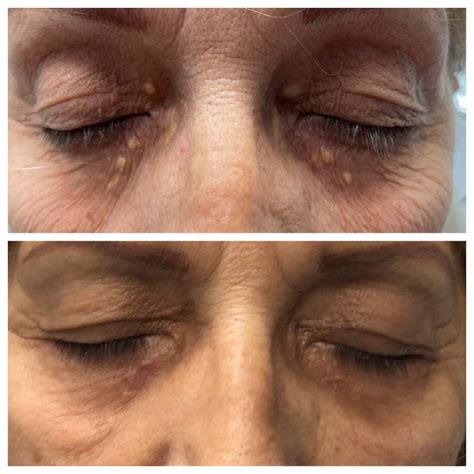 Xanthelasma Treatment St. Louis Dermatology & Cosmetic Surgery