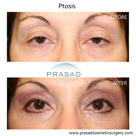 Ptosis Surgery | Eyelid Droop Correction New York - Amiya Prasad MD