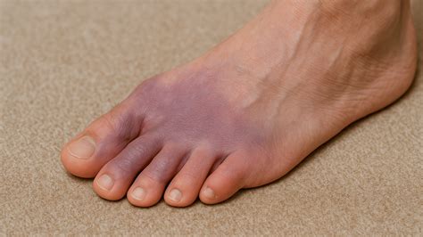 Why Are My Feet Turning Purple? | Fall Creek Foot & Ankle