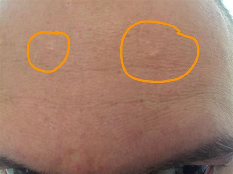 Lumps On Forehead Small Bumps On Forehead: Causes And How To Get Rid