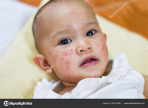 Dry Skin Rashes On Baby Face at Imelda Metzger blog